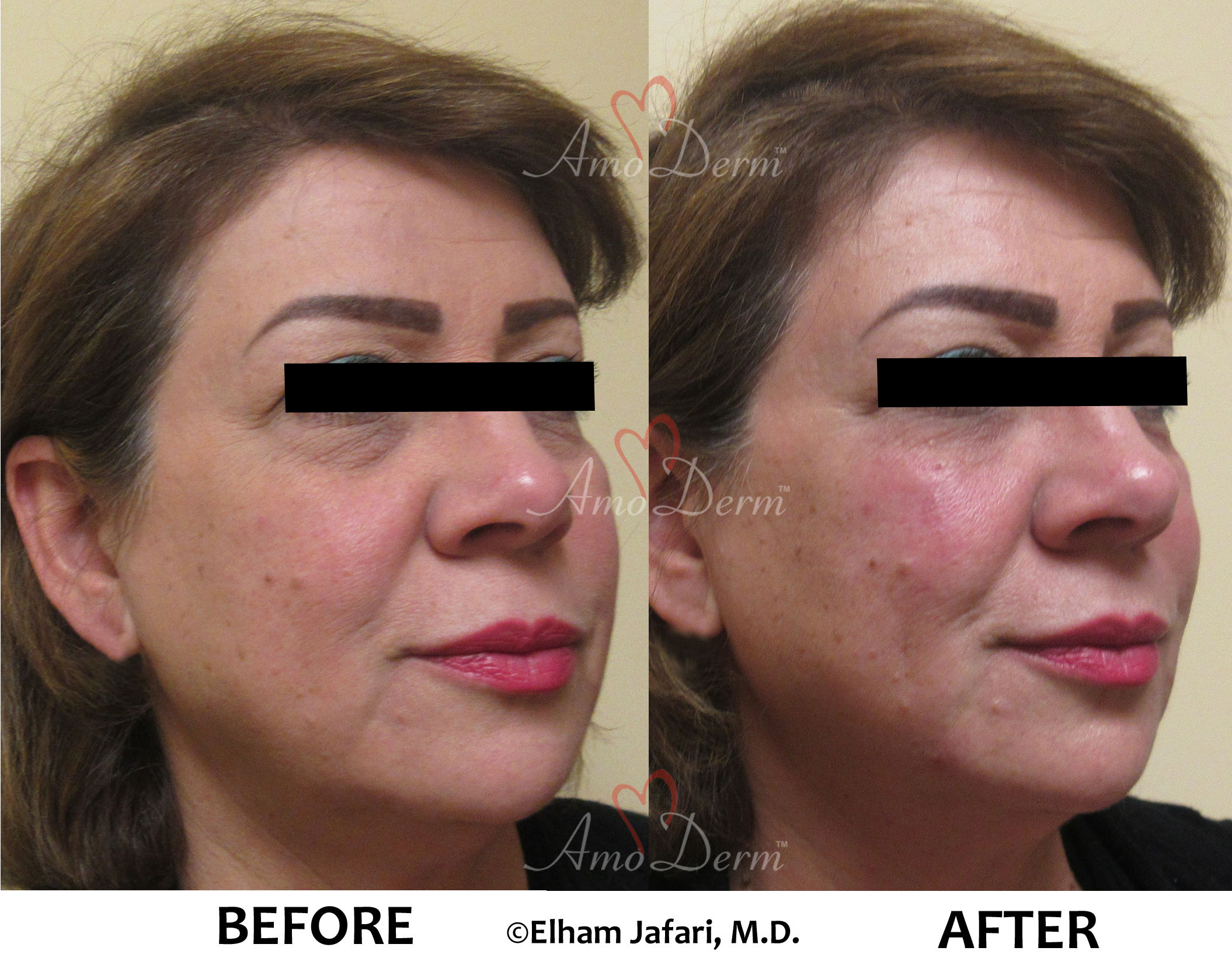 Dark Circles Under Eyes Cosmetic Treatments Before and After Pictures