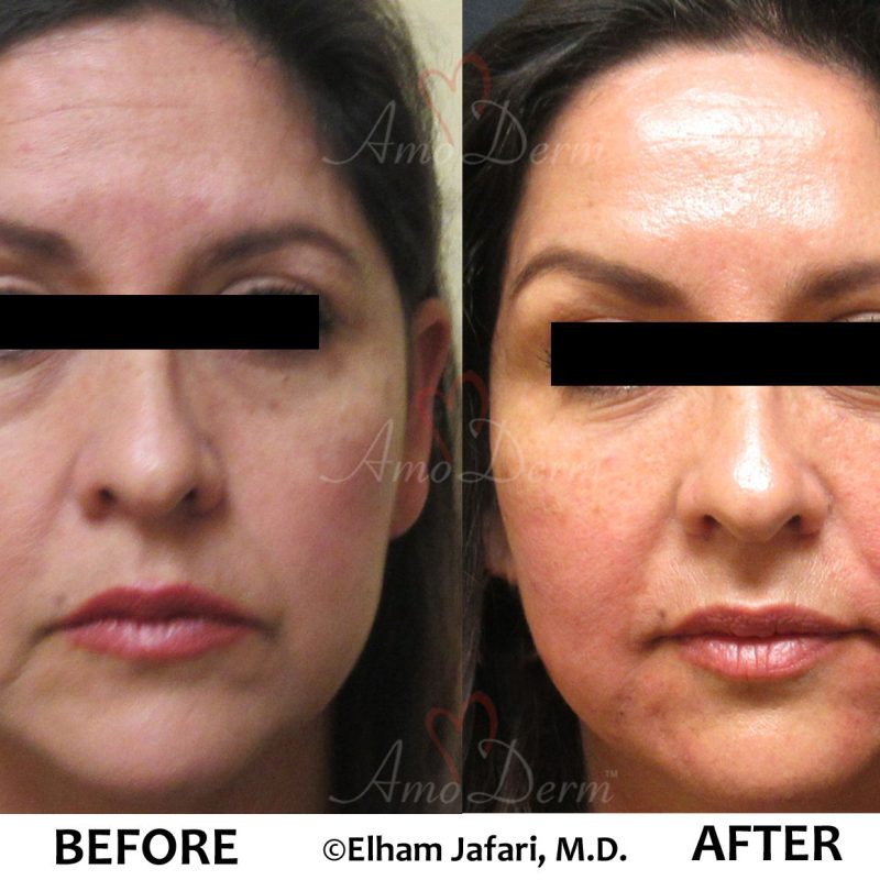 Liquid Facelift and Dark Circles Under Eyes