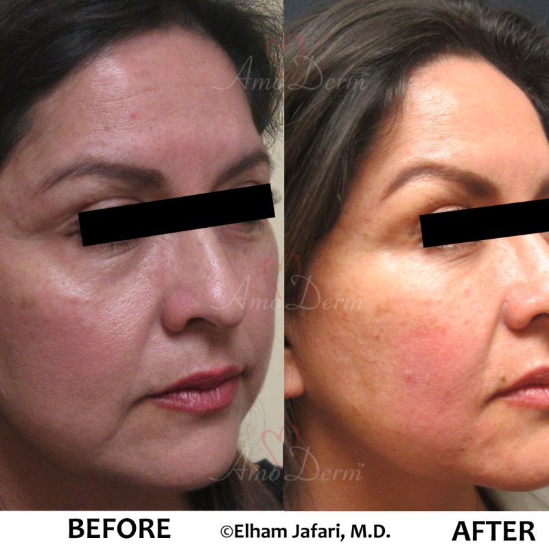 Liquid Facelift and Dark Circles Under Eyes