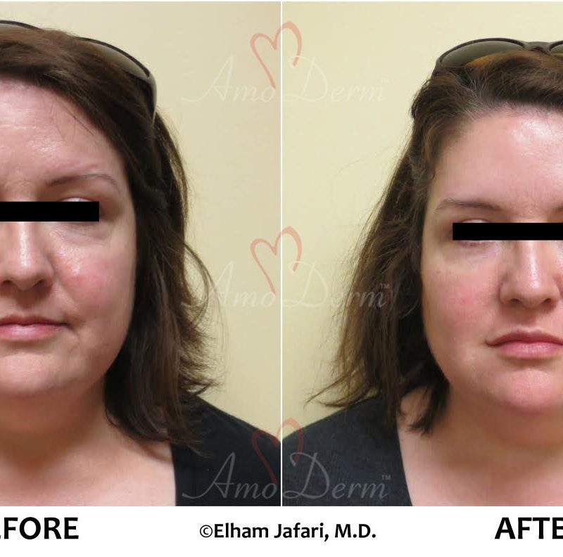 Liquid Facelift