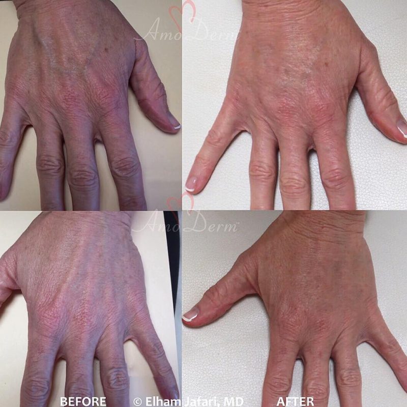 Hand Rejuvenation