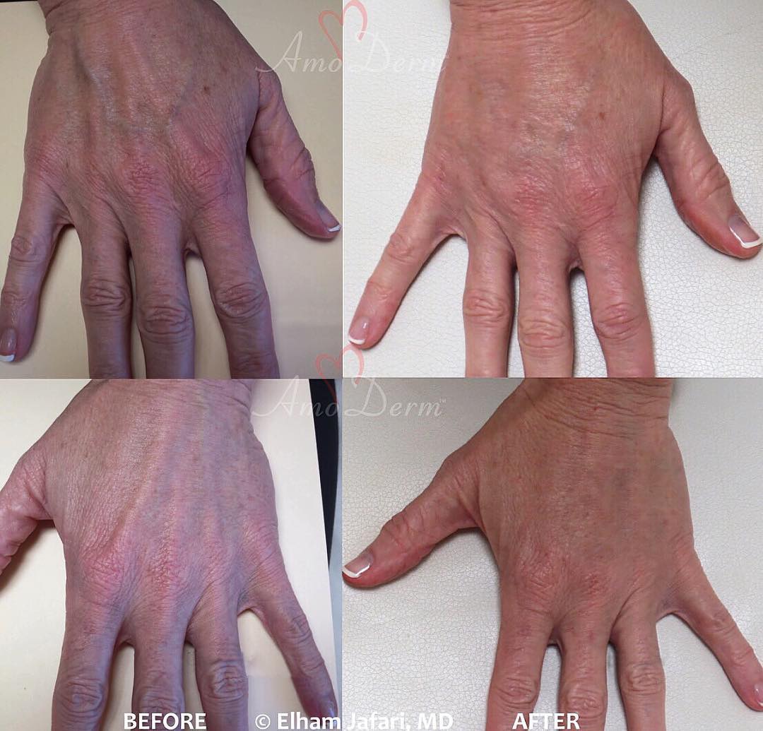 Irvine & Newport Beach Hand Rejuvenation Orange County Fillers