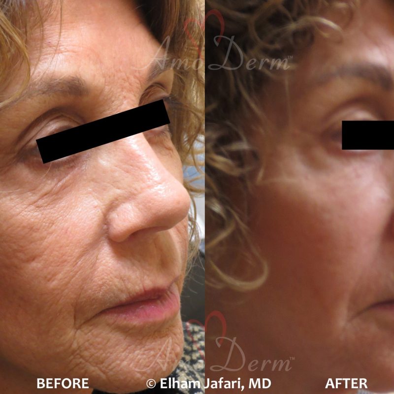 Fractional CO2 Laser Treatment