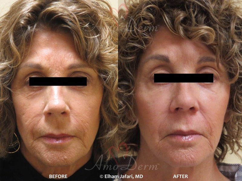 Fractional CO2 Laser Treatment