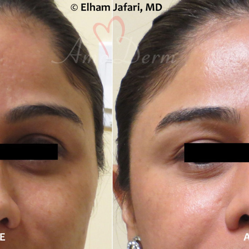 Fractional CO2 Laser Skin Resurfacing Cosmetic Treatments Before and After Pictures Fractional CO2 Laser Skin Resurfacing