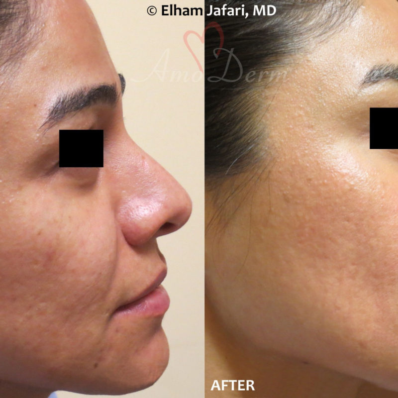 Fractional CO2 Laser Skin Resurfacing Cosmetic Treatments Before and After Pictures Fractional CO2 Laser Skin Resurfacing