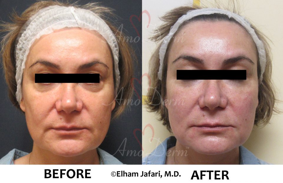 Liquid Facelift