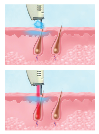 How Laser Hair Removal Works How Laser Hair Removal Works