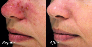 IPL Acne IPL Acne