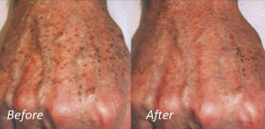 IPL Damaged Skin IPL Damaged Skin