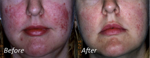 IPL Vascular Lesions IPL Vascular Lesions