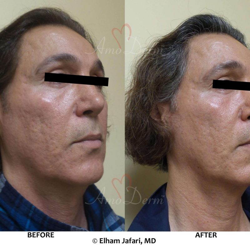Treatment of acne scars with Fractional CO2 laser skin resurfacing