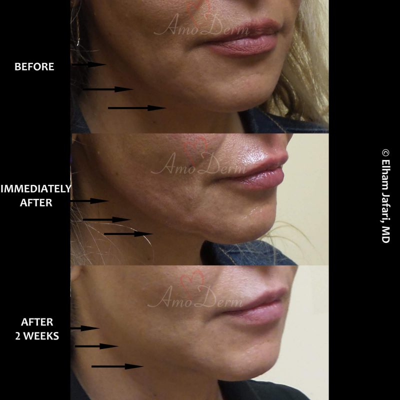 Filler for lower face &amp; jawline sculpting &amp; contouring to create a chisled jawline (Voluma, Bellafill, Radiesse)