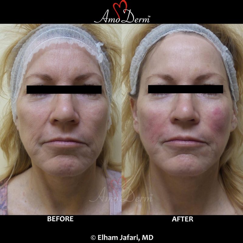 Liquid Facelift with PDO Thread (thread lift) in mid face (cheeks and nasolabial folds, laugh lines)