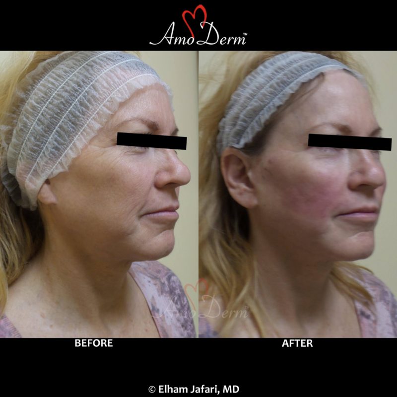 Liquid Facelift with PDO Thread (thread lift) in mid face (cheeks and nasolabial folds, laugh lines)