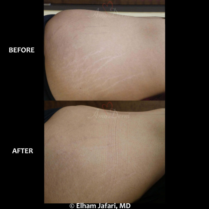 Treatment of stretch marks with Fractional CO2 laser (CO2 Laser Skin Resurfacing)