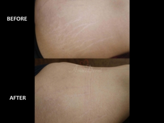 Treatment of stretch marks with Fractional CO2 laser (CO2 Laser Skin Resurfacing) Treatment of stretch marks with Fractional CO2 laser (CO2 Laser Skin Resurfacing)