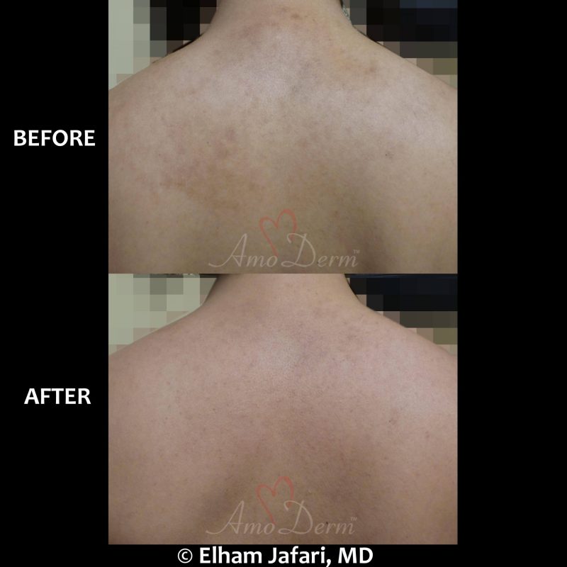 Microlaser Peel - Erbium laser skin resurfacing