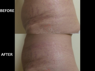 Treatment of stretch marks with Fractional CO2 laser (CO2 Laser Skin Resurfacing) Treatment of stretch marks with Fractional CO2 laser (CO2 Laser Skin Resurfacing)