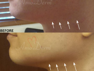 Jawline contouring and chin augmentation with dermal fillers