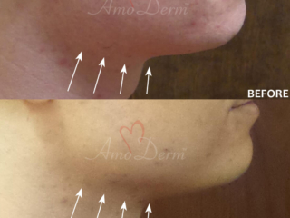 Jawline contouring and chin augmentation with dermal fillers