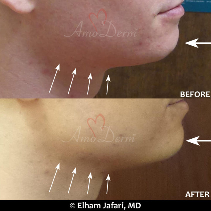 Jawline contouring and chin augmentation with dermal fillers