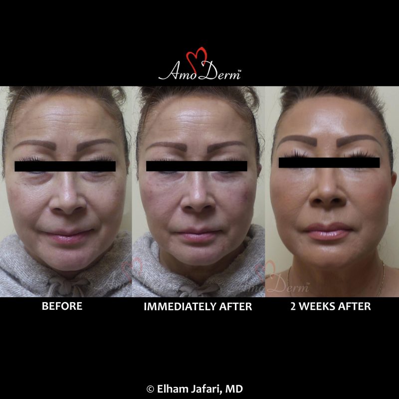 Liquid facelift with filler injection