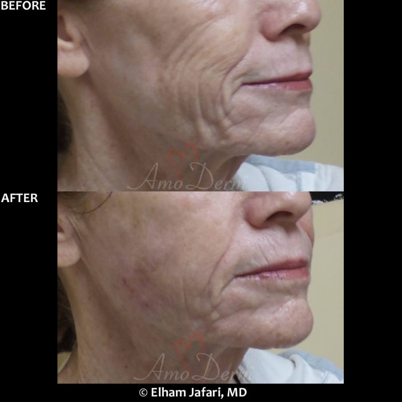 Liquid facelift with filler injection