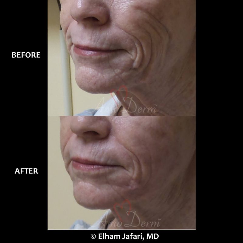 Liquid facelift with filler injection