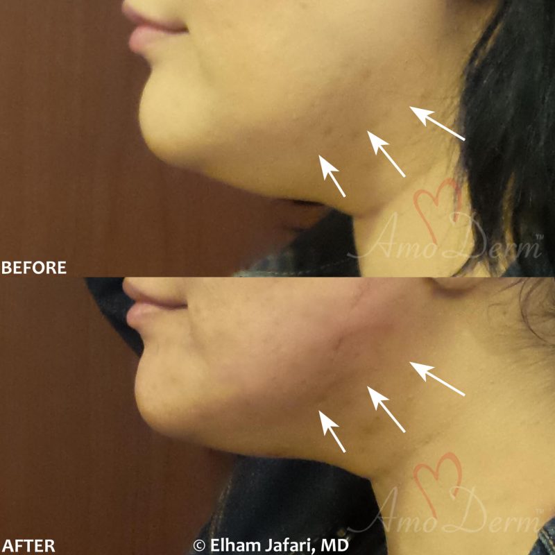 Jawline contouring and restoration with fillers