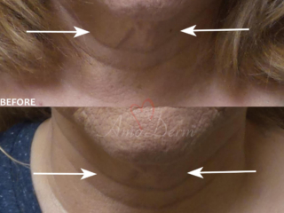 Nonsurgical skin tightening and lifting with Ultherapy