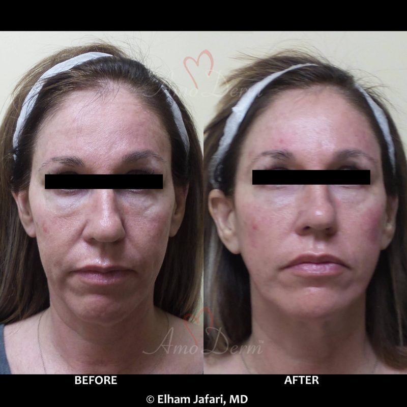 Liquid Facelift with filler injection in jawlines, necklines, temples, under the eyes &amp; cheeks