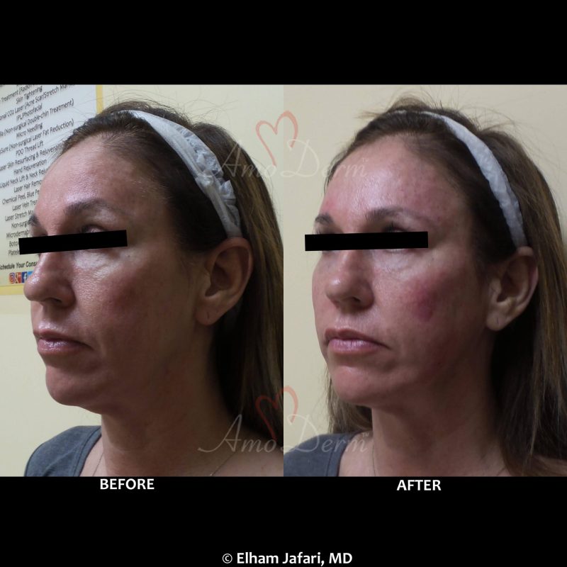 Liquid Facelift with filler injection in jawlines, necklines, temples, under the eyes &amp; cheeks