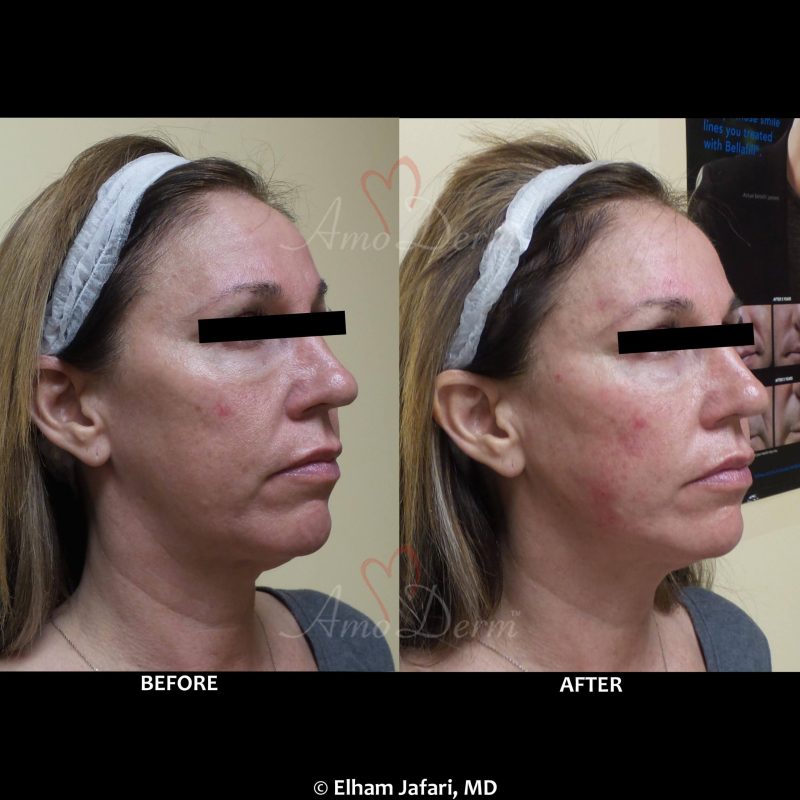 Liquid Facelift with filler injection in jawlines, necklines, temples, under the eyes &amp; cheeks