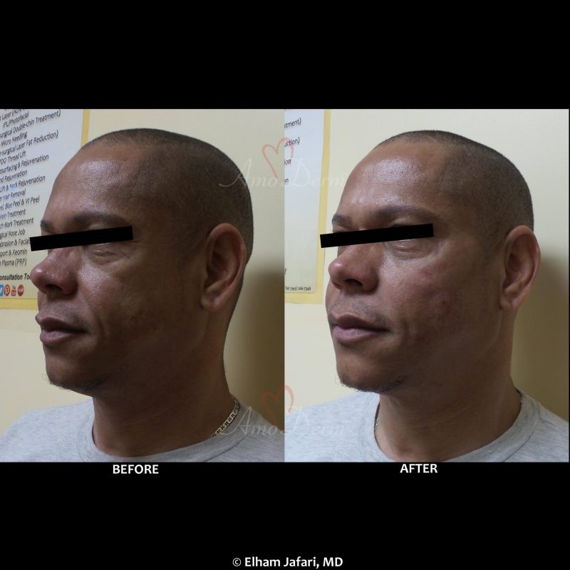 Liquid Facelift with filler injection in cheeks and nasolabial folds (laugh lines)
