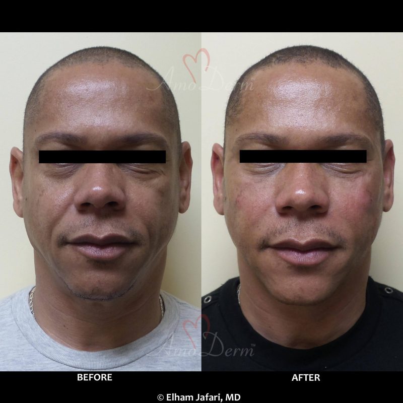 Liquid Facelift with filler injection in cheeks, under eyes and nasolabial folds (laugh lines)