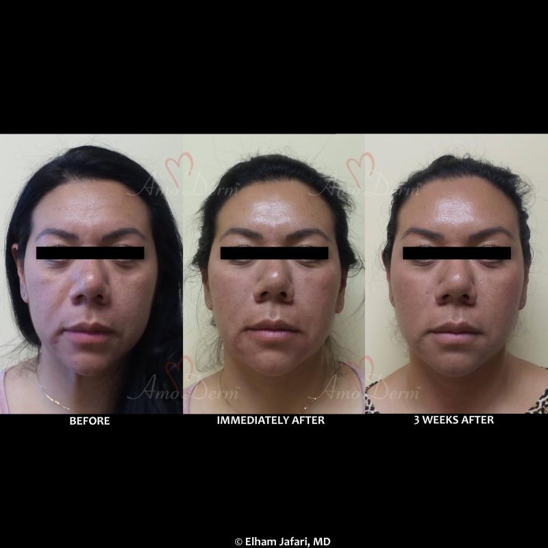 Liquid facelift with Botox in forehead &amp; filler in under the eyes, cheeks, &amp; marionette lines