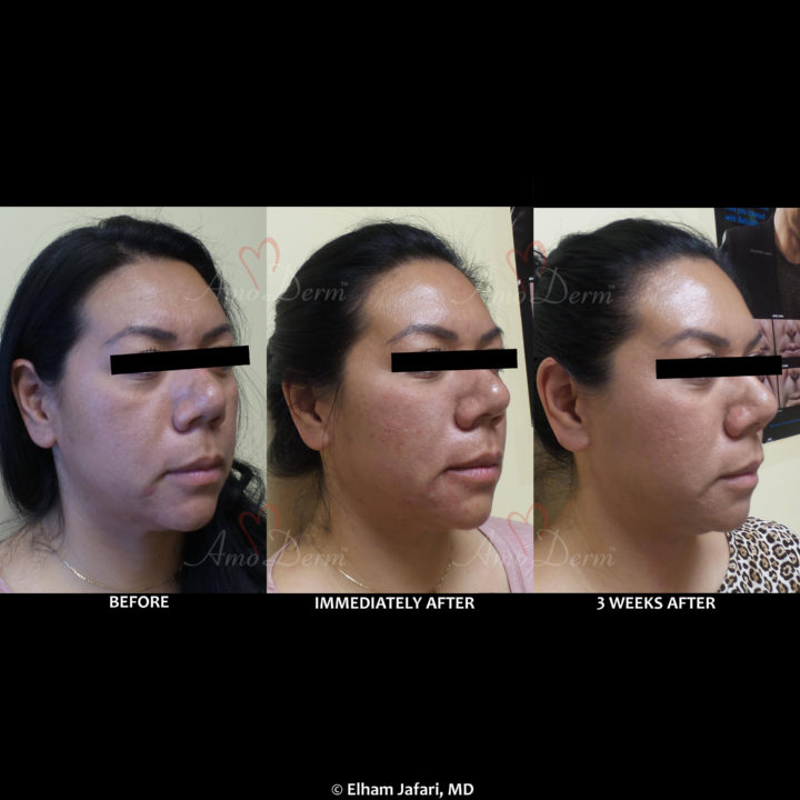 Liquid facelift with Botox in forehead & filler in under the eyes, cheeks, & marionette lines