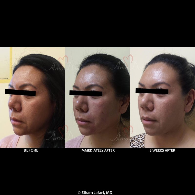 Liquid facelift with Botox in forehead &amp; filler in under the eyes, cheeks, &amp; marionette lines