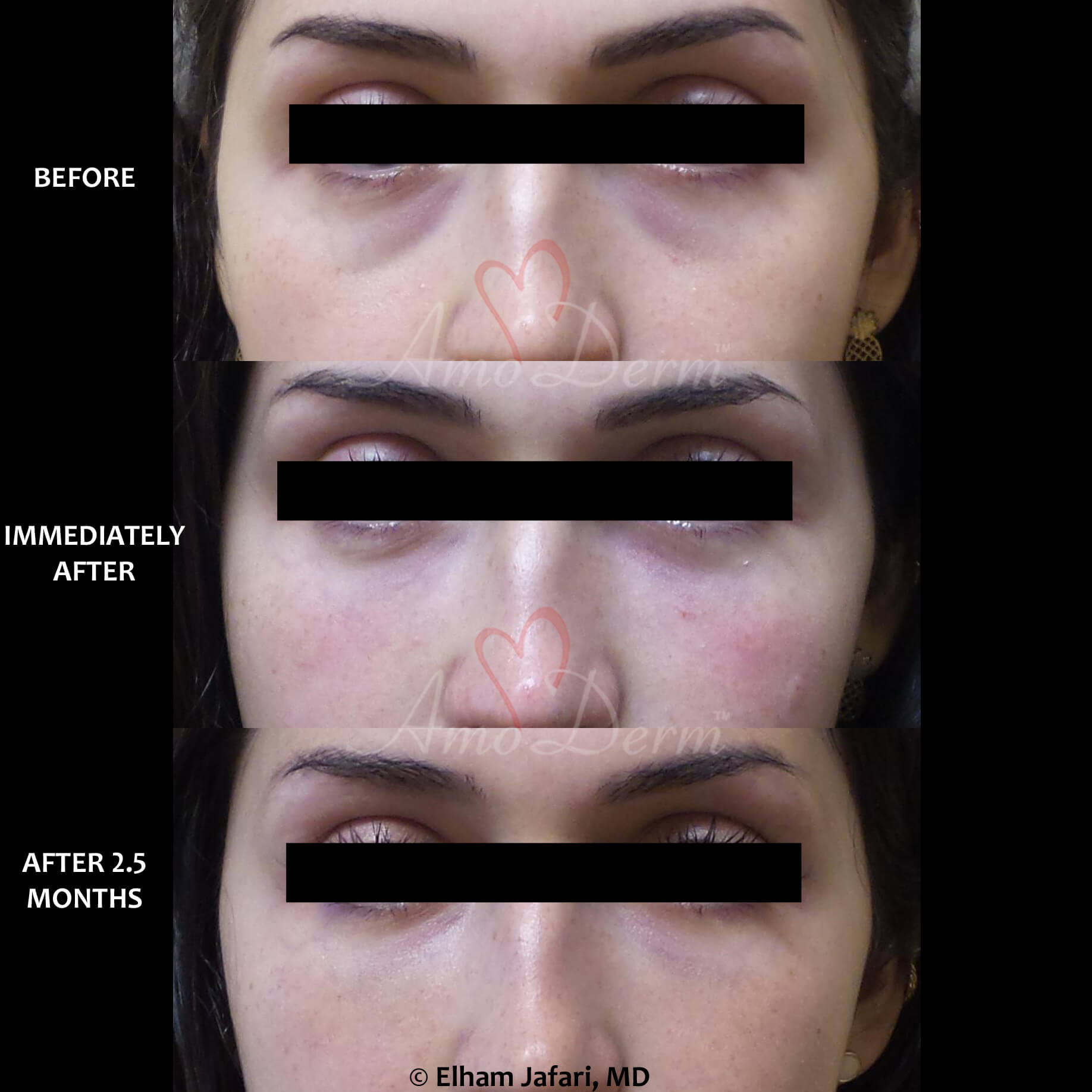 Treat dark circles & bags under eyes using fillers & lasers