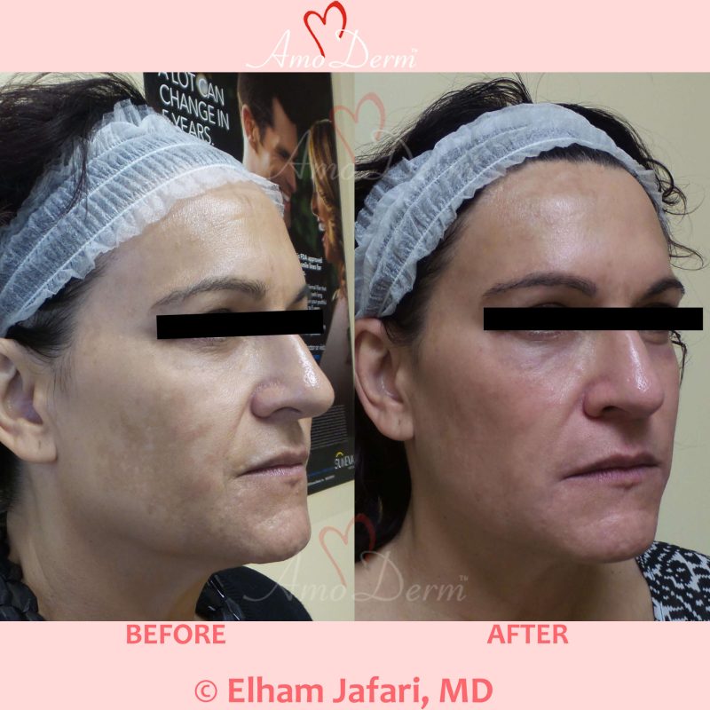 Microlaser Peel - Erbium laser skin resurfacing