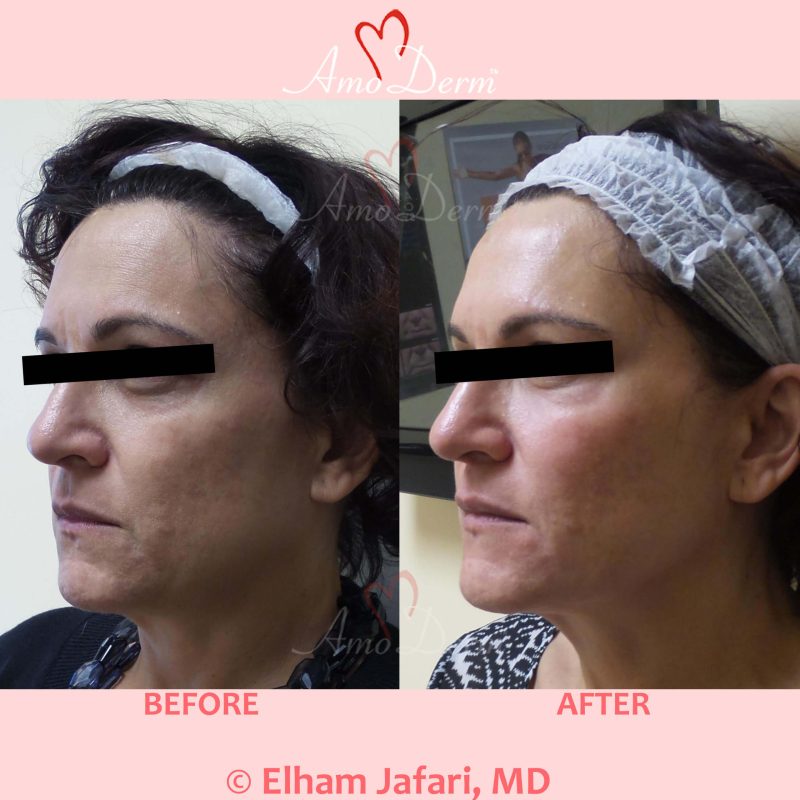 Microlaser Peel - Erbium laser skin resurfacing