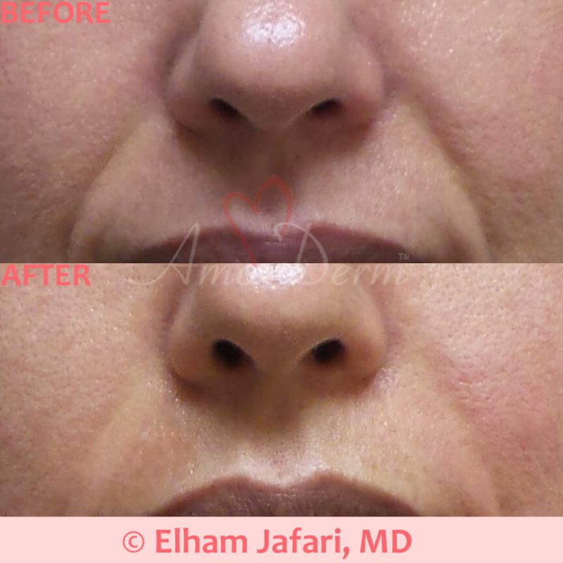 Treatment of nasolabial folds as part of non-surgical facelift