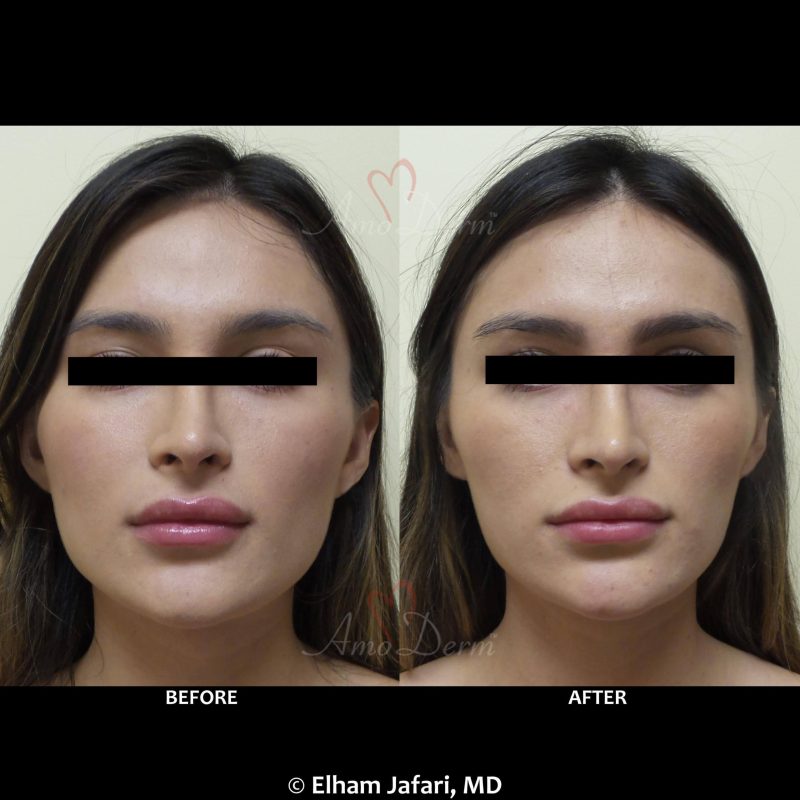 Facial slimming (jaw slimming or jaw reduction) is known as cosmetic facial injection