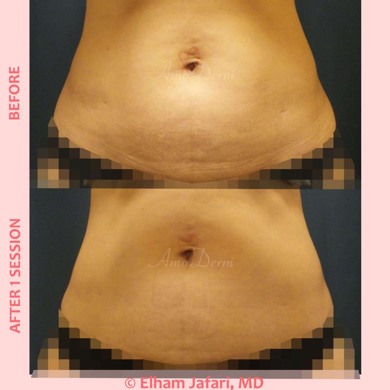 SculpSure Stubborn Fat Reduction