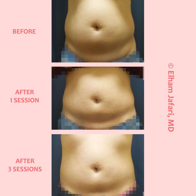 SculpSure Stubborn Fat Reduction