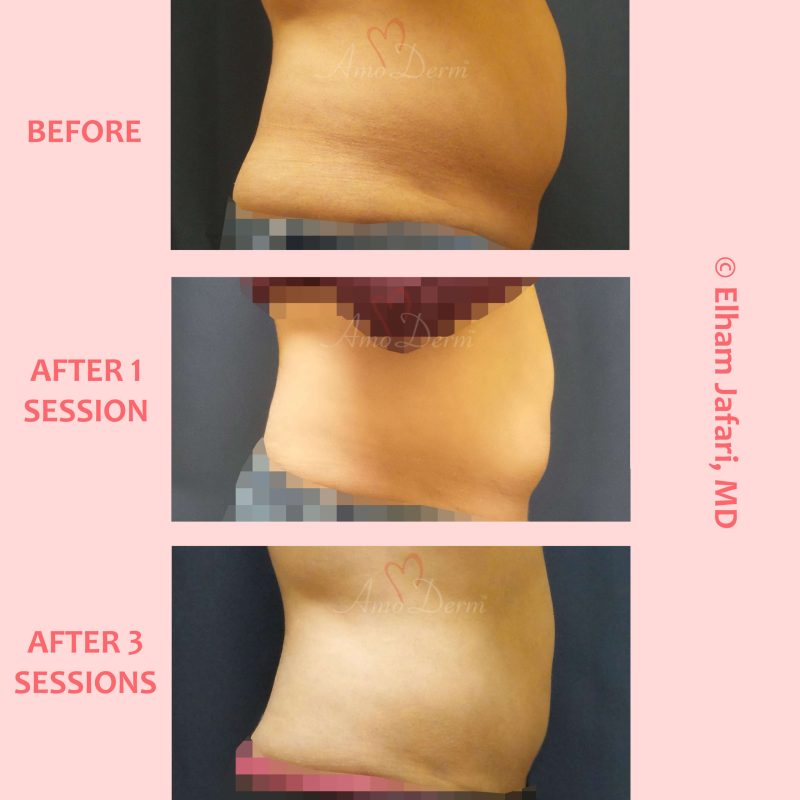 SculpSure Stubborn Fat Reduction