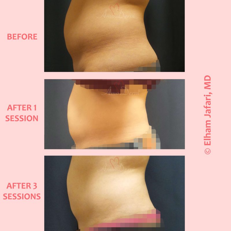 SculpSure Stubborn Fat Reduction