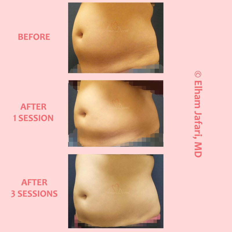 SculpSure Stubborn Fat Reduction