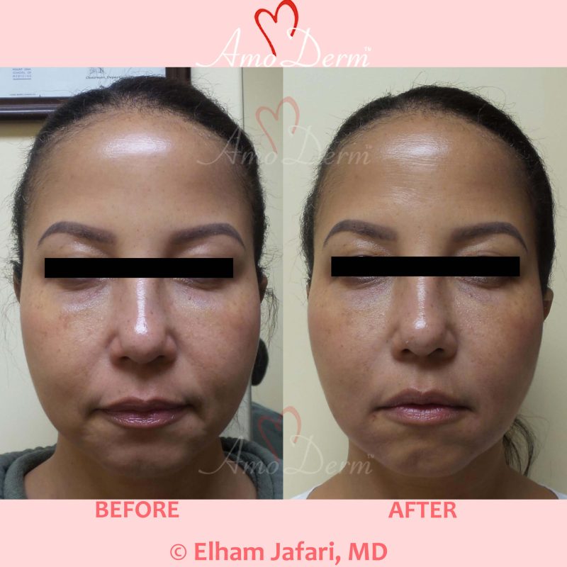 Liquid Facelift with injection of fillers in nasolabial folds &amp; marionette lines